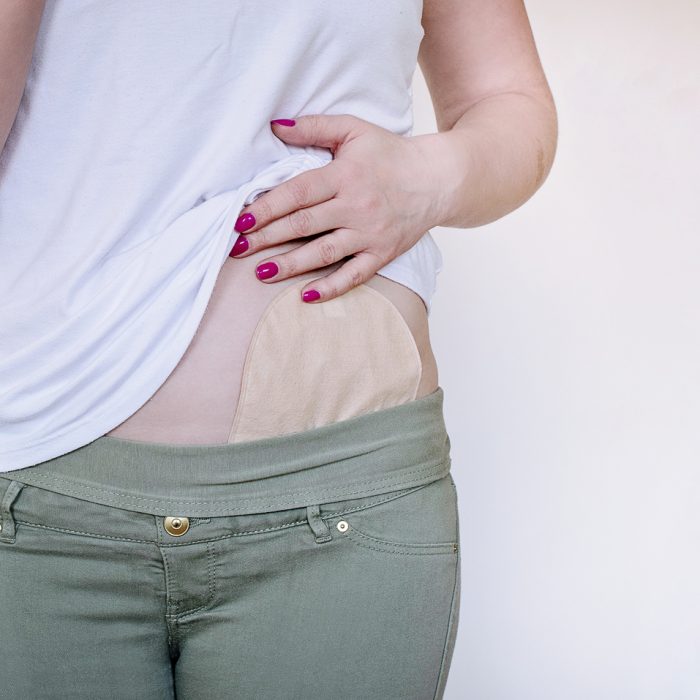 Front view on colostomy pouch in skin color attached to young woman patient. Close-up on ostomy bag after surgery. Medical theme.